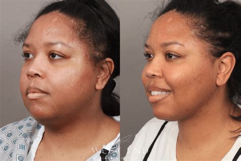 Boka Operation: Buccal fat pad removal .